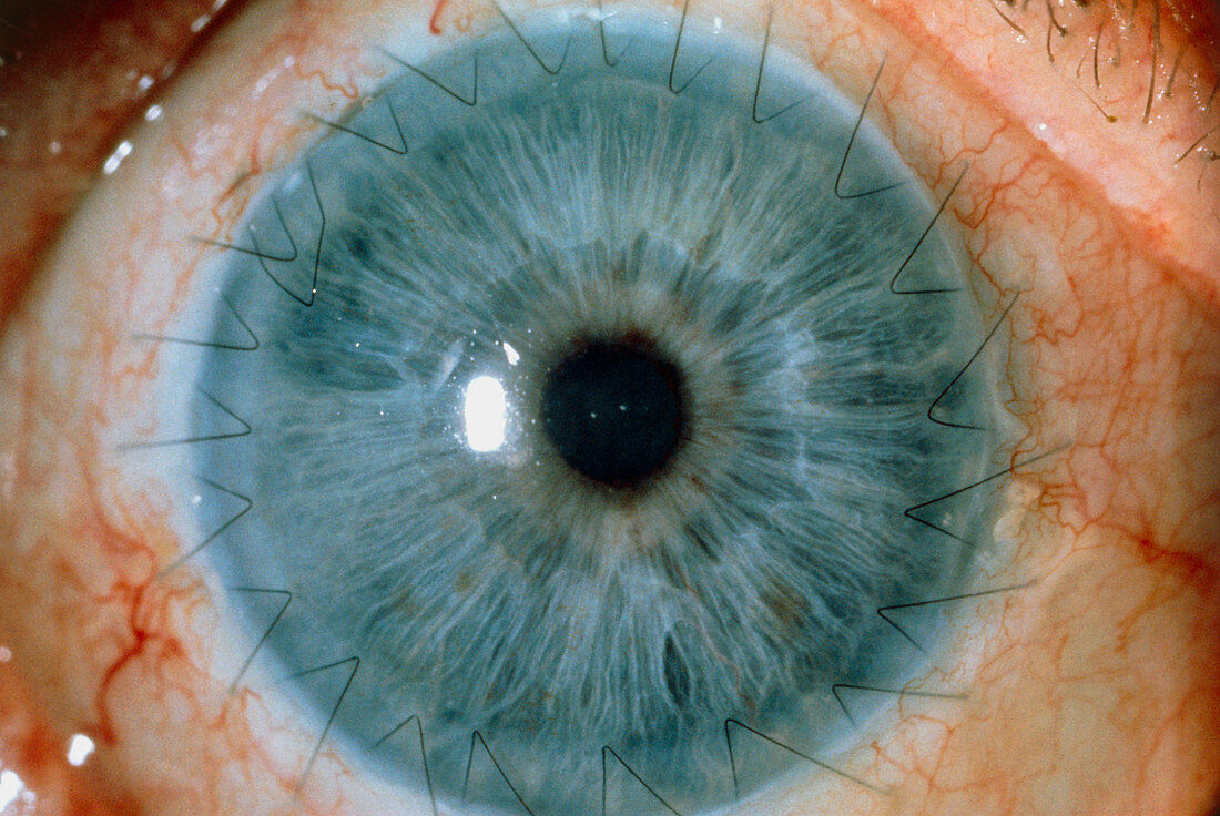 Close-up of eye showing corneal graft