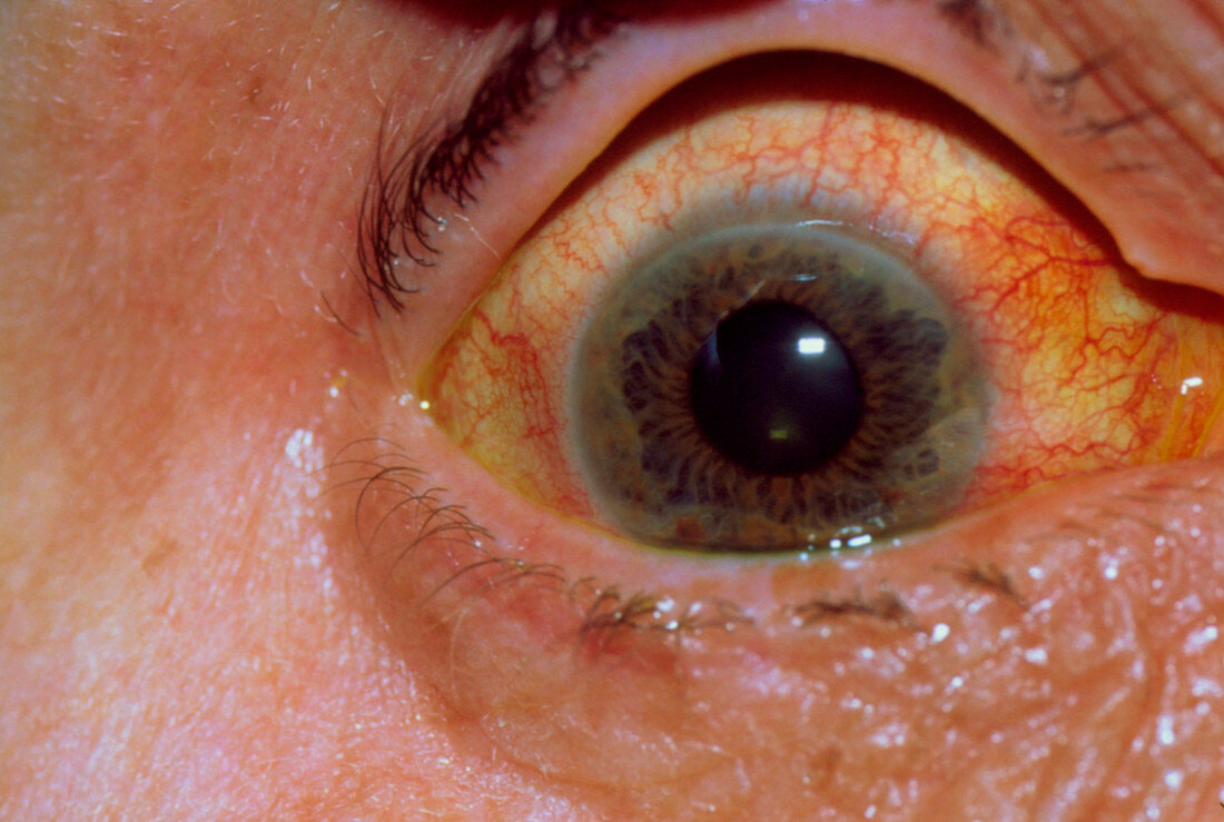 Glaucoma: close-up of inflamed eye