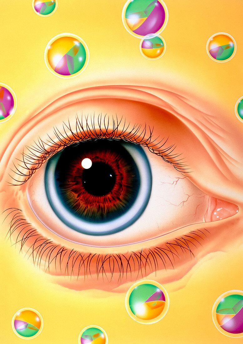 Illustration of arcus senilis condition of the eye