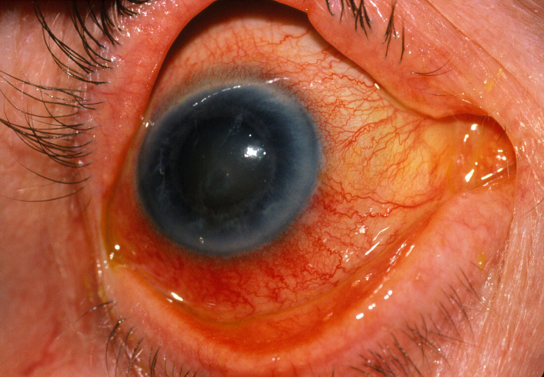 Acute glaucoma of the eye