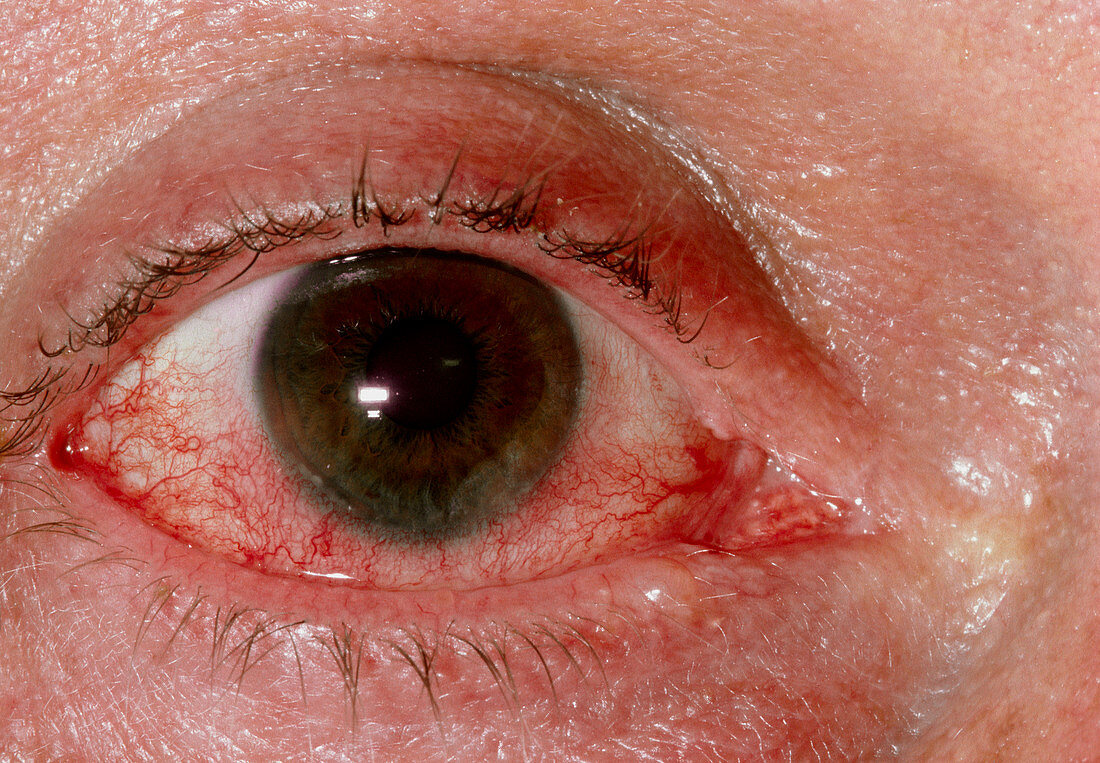 Close-up of eye affected by viral conjunctivitis