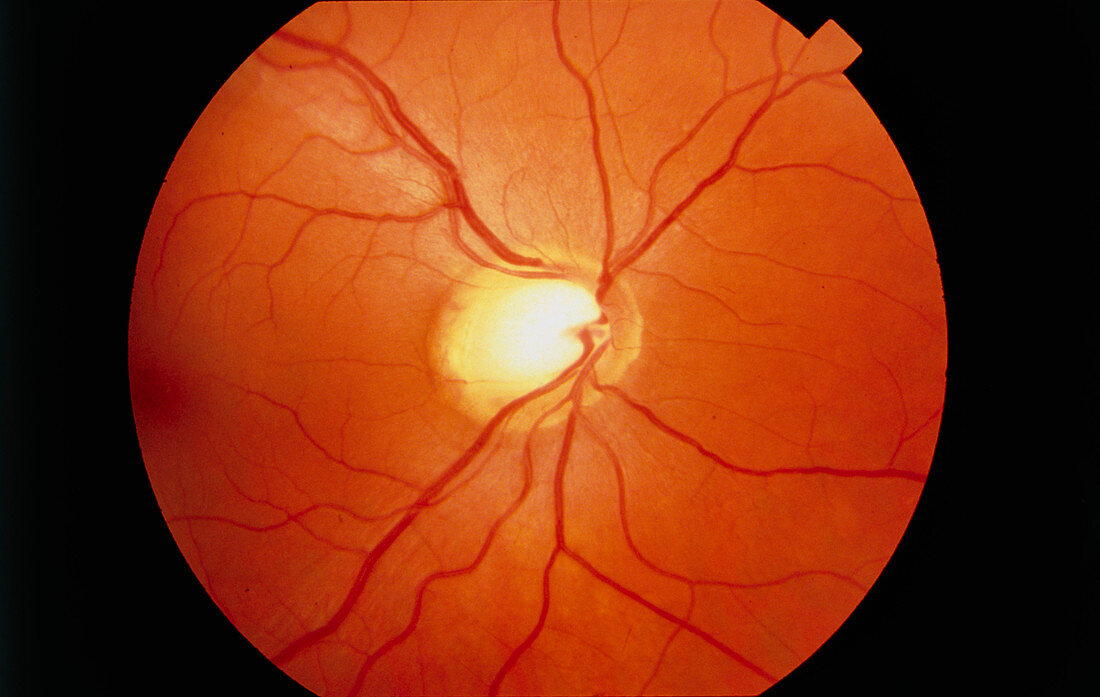 Fundus camera image: cupping of disc in glaucoma