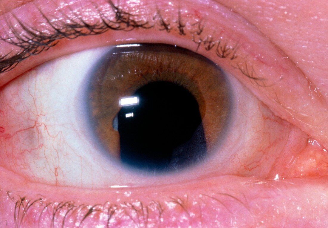 Close up of eye showing COLOBOMA