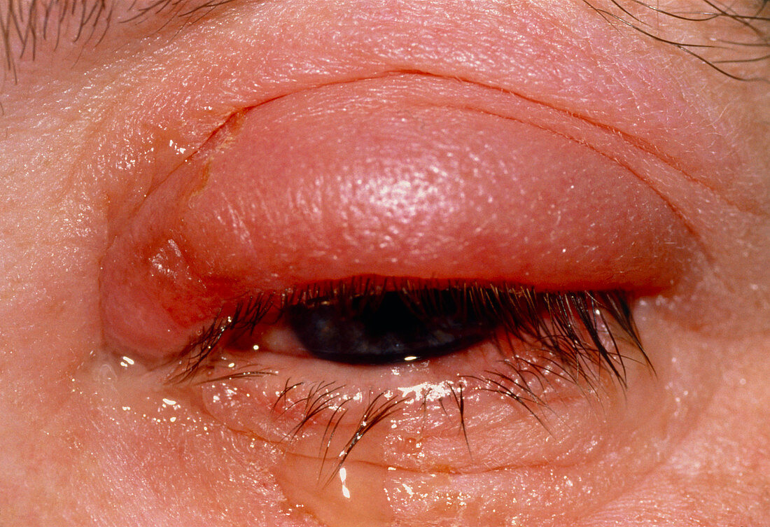 Swollen,red eye with conjunctivitis