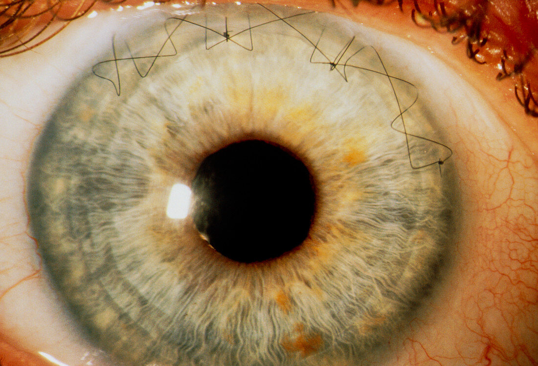 Sutures in an eye from congenital cataract surgery