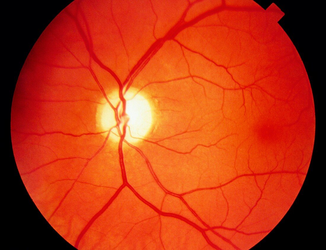 Ophthalmoscope view of retina with optic atrophy