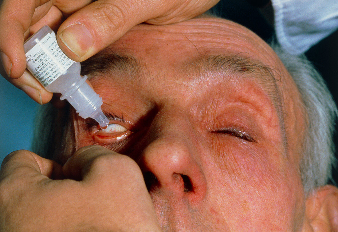 Mydriatic eye drops being put in man's eye