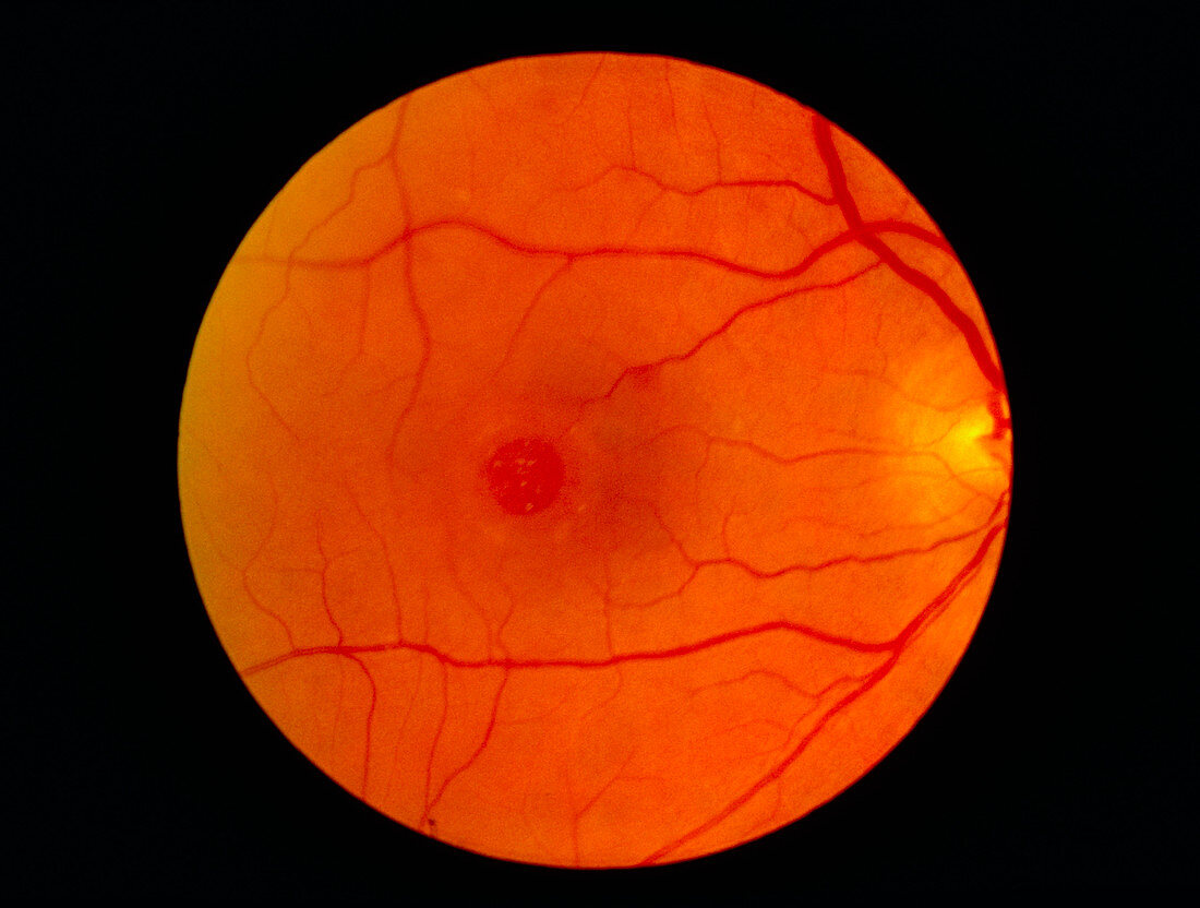 Ophthalmoscope view of retina showing macula hole