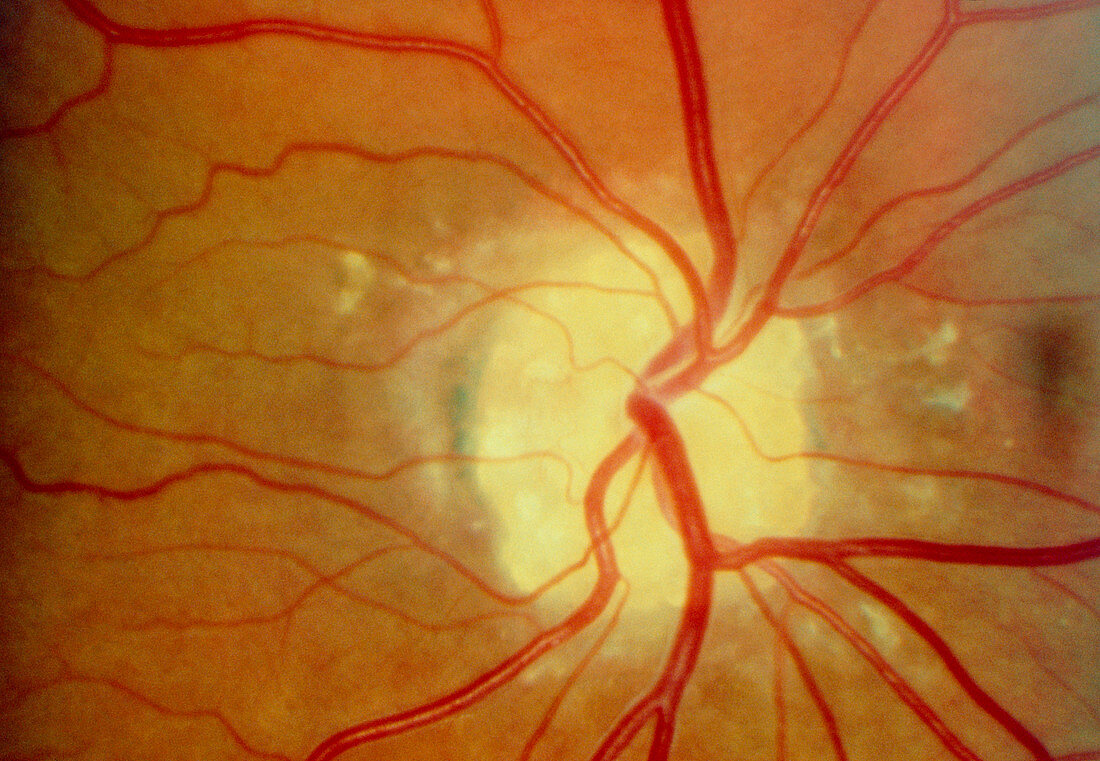 Ophthalmoscopy of retina showing optic disc drusen