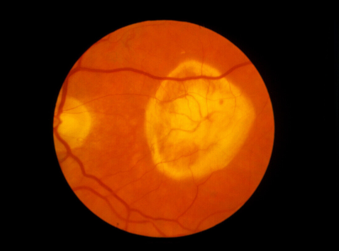 Ophthalmoscopy of disciform macula degeneration