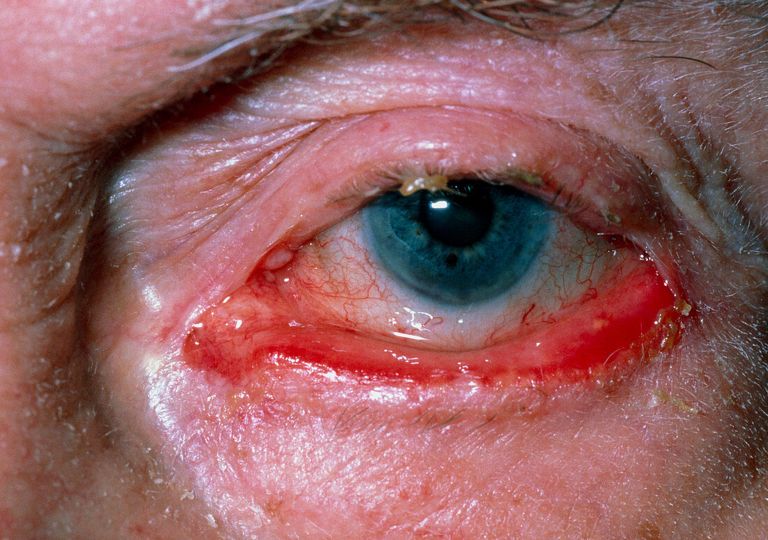Ectropion of the lower eyelid