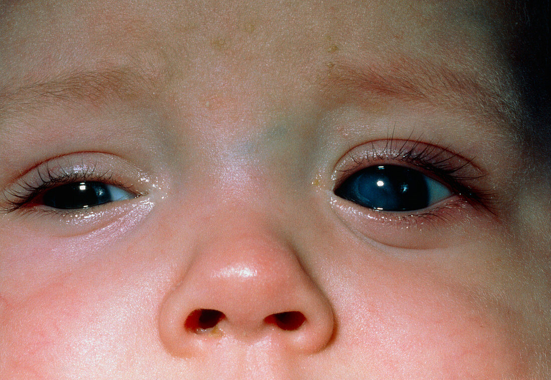 Child's eye with retrolental fibroplasia