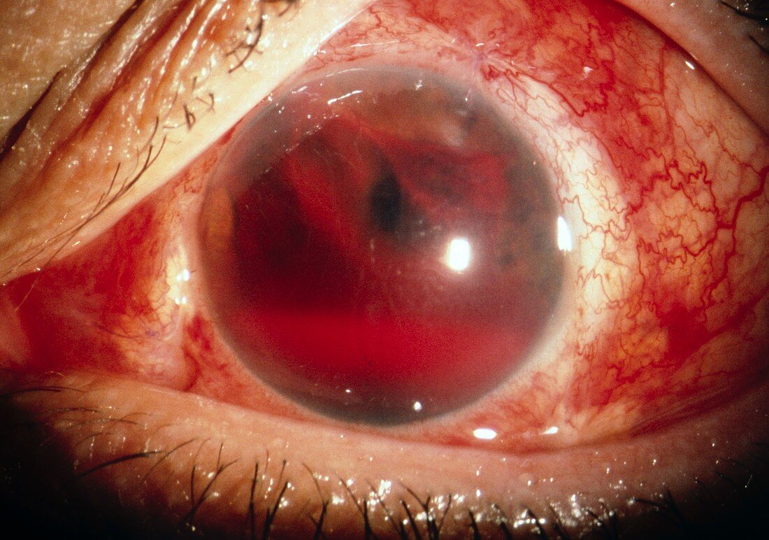 Bleeding eye of patient with rubeosis iridis