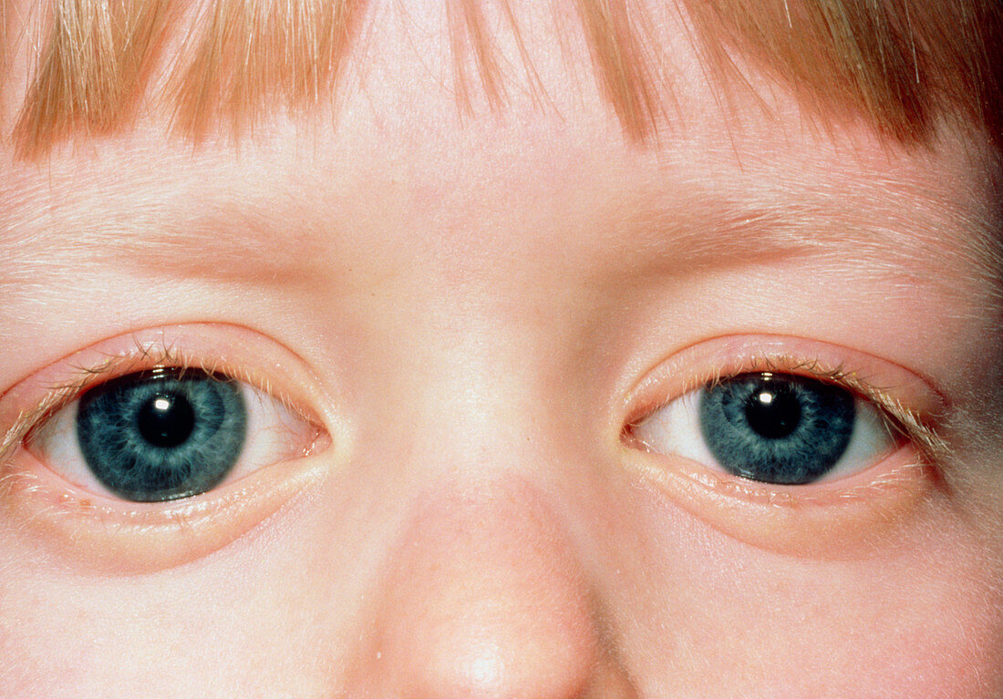 Eyes of a child with congenital glaucoma