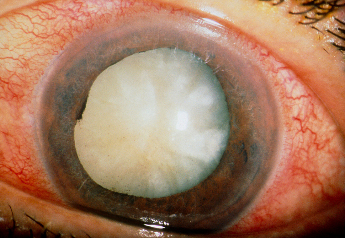 Close up of an eye with a phaco-optic glaucoma
