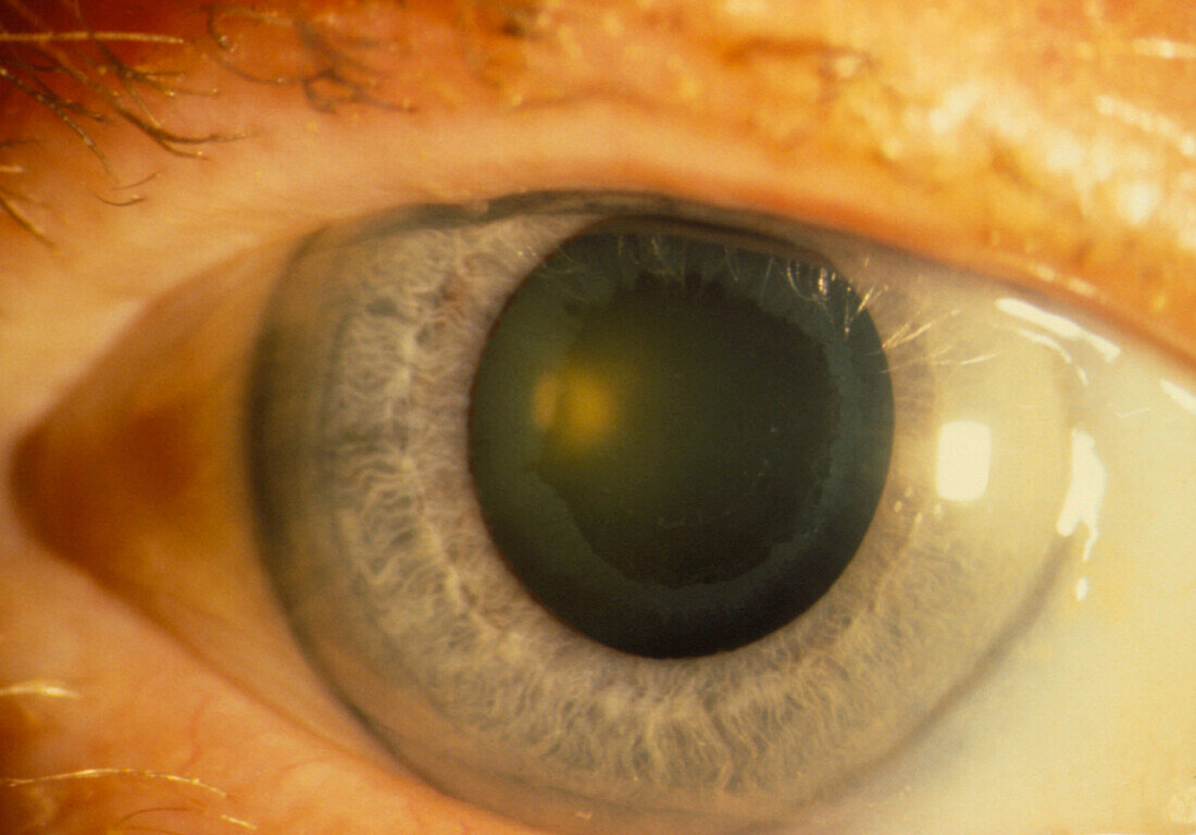 Close up of an eye with glaucoma damaging lens