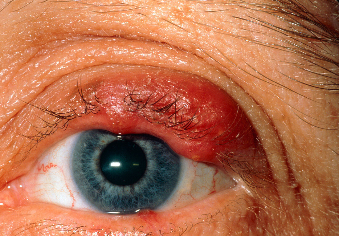 Close up of eye with meibomian abscess