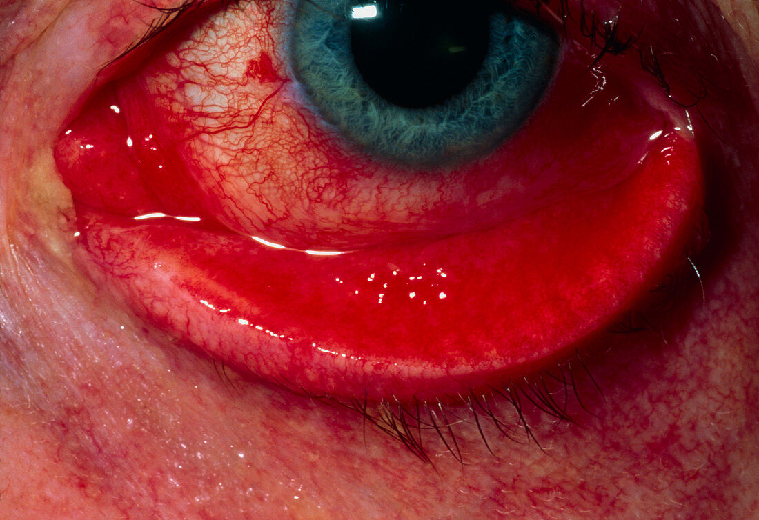 Allergic conjunctivitis: close up of eye