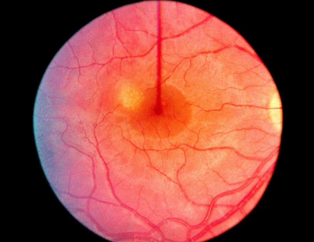 Ophthalmoscopy of retina damage by heroin abuse