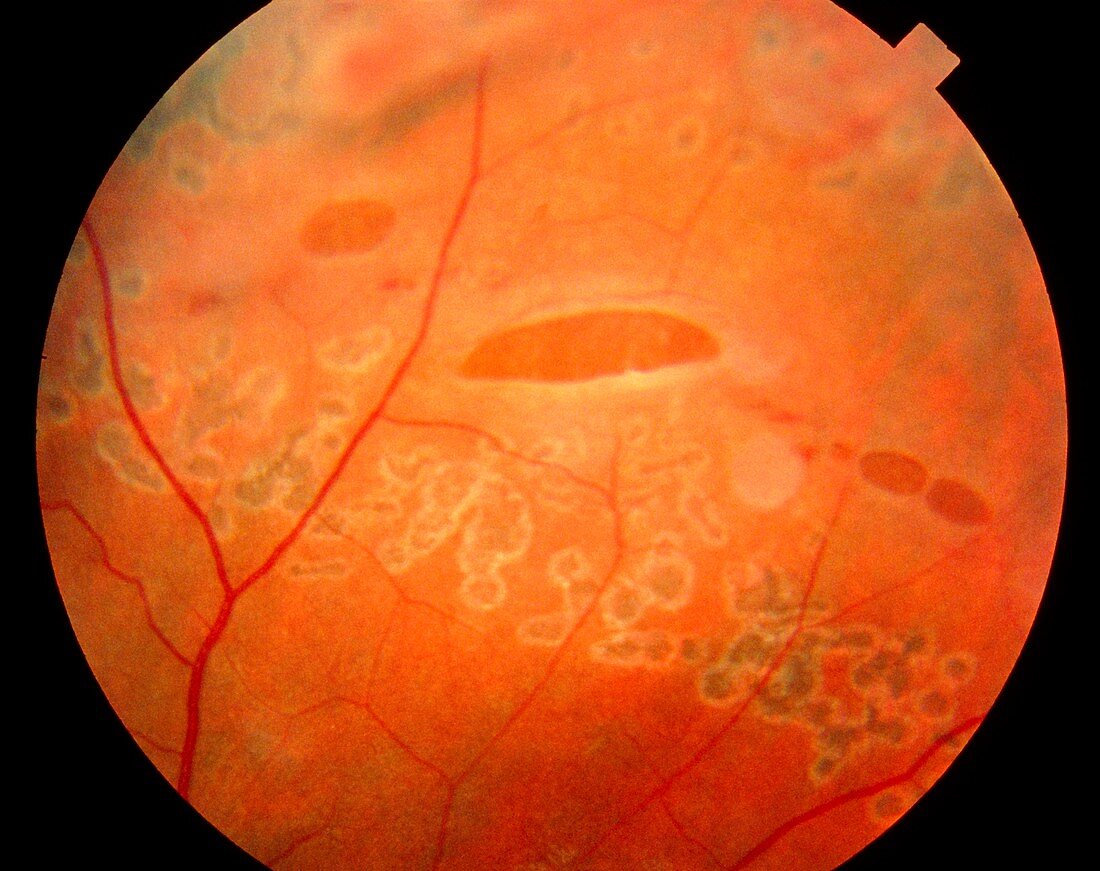 Ophthalmoscopy view of torn retina in eye