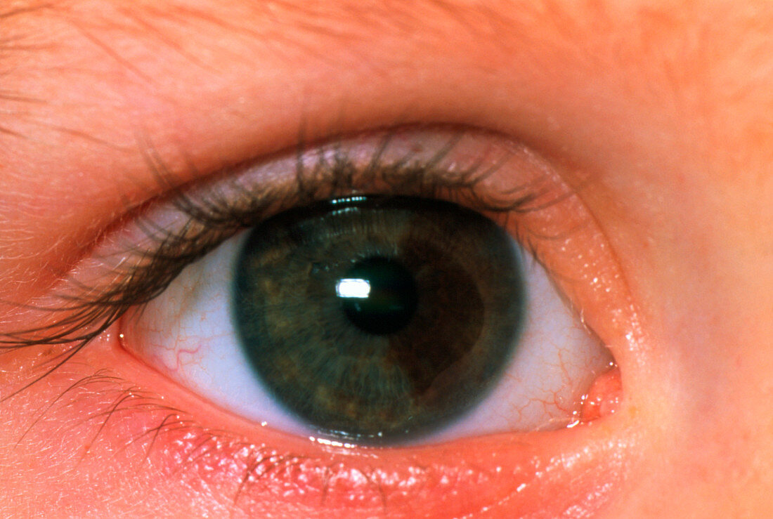 Close-up of a benign naevus in a child's iris