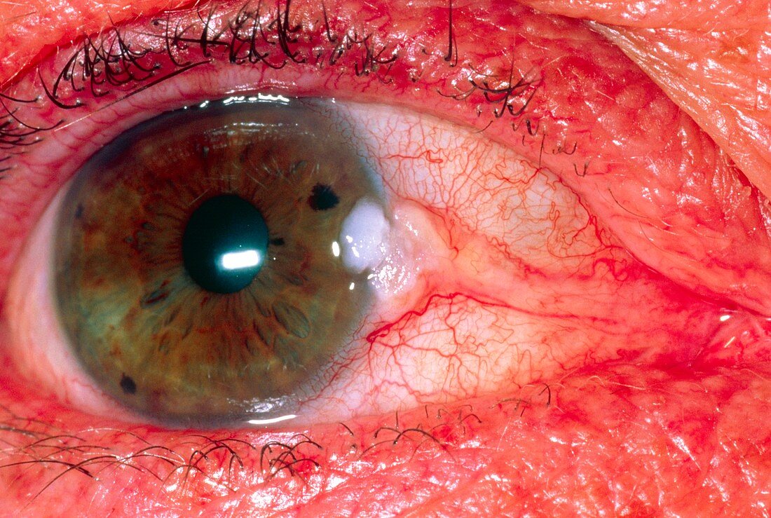 View of an eye showing pterygium