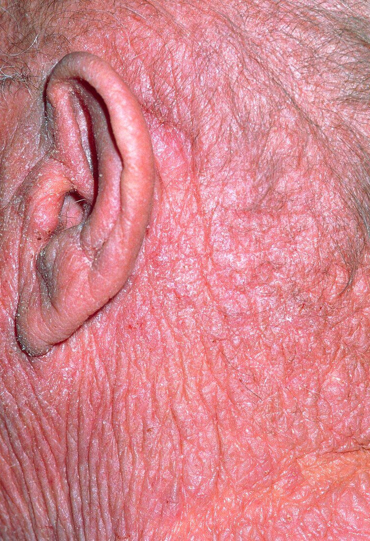 Lichenification caused by eczema on a man's head