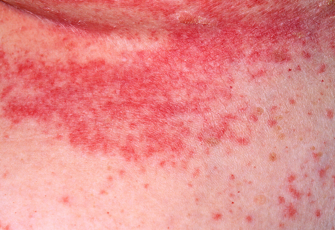 Seborrheic eczema