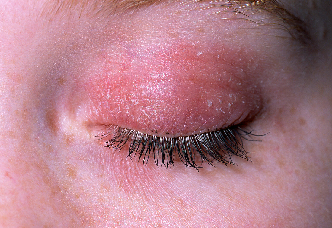 Eczema on eyelid