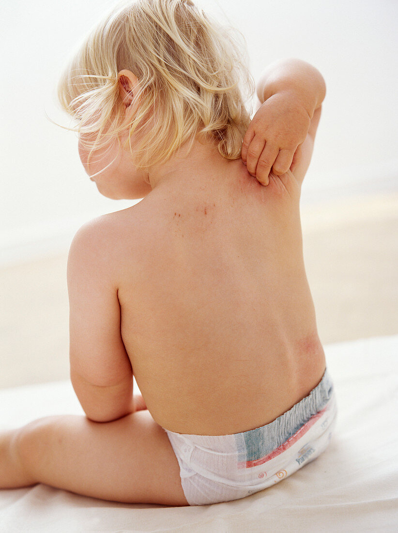 Eczema on a baby's back