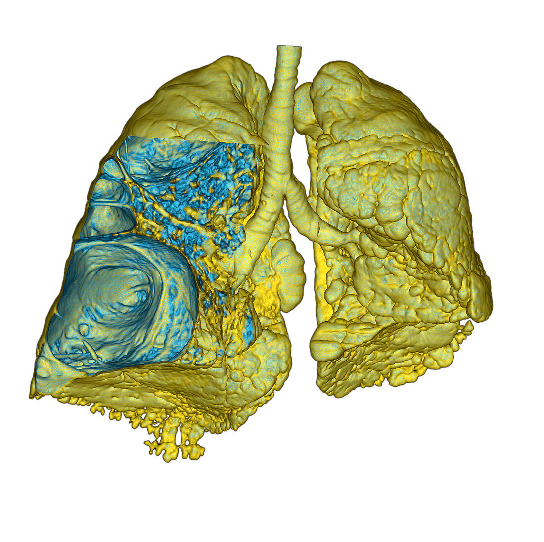 Emphysema of the lungs,CT scan