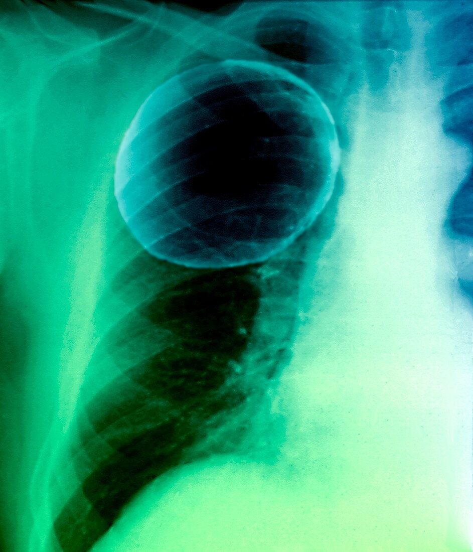 Emphysema,X-ray