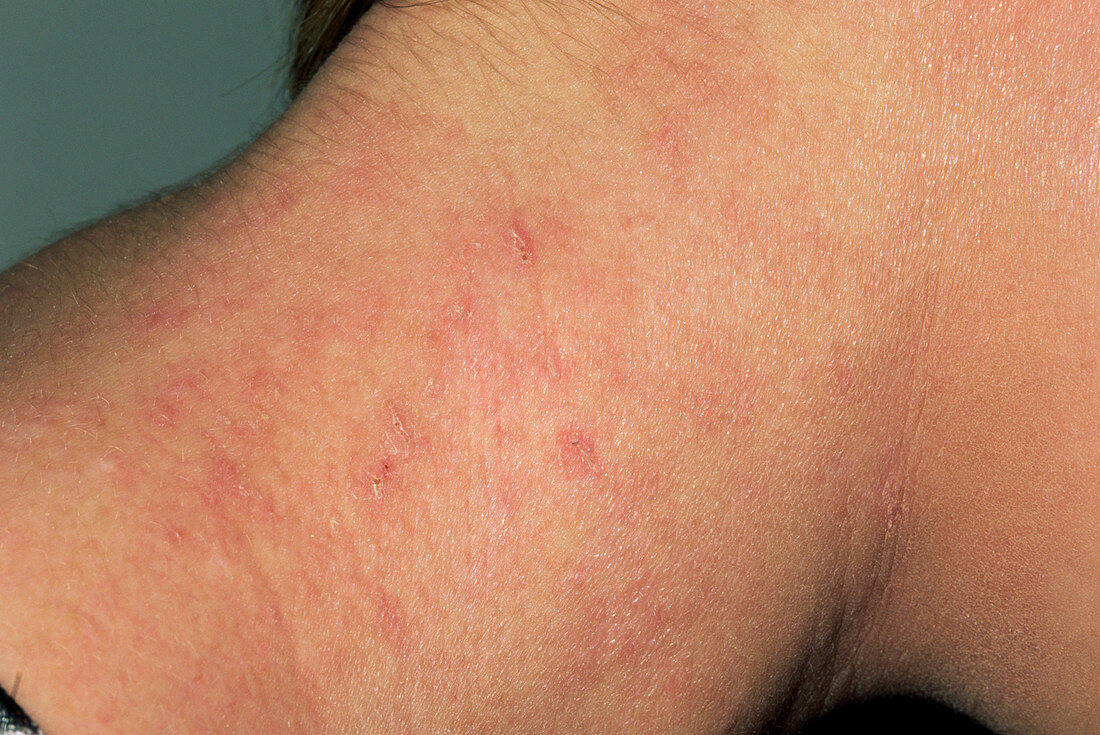 Eczema following treatment