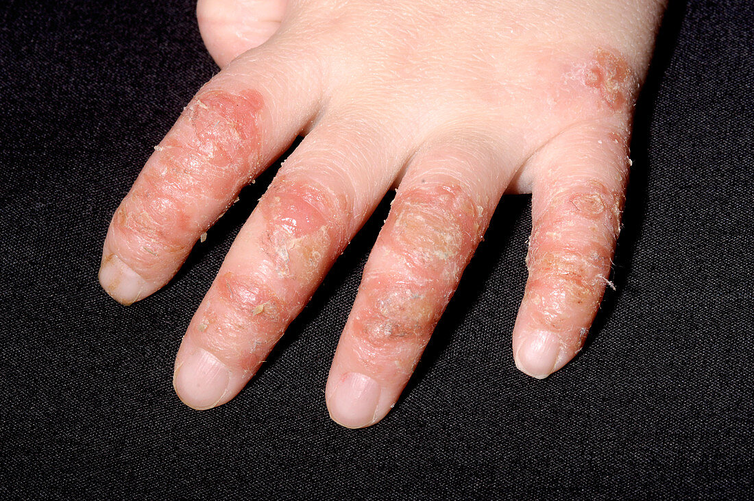 Infected eczema