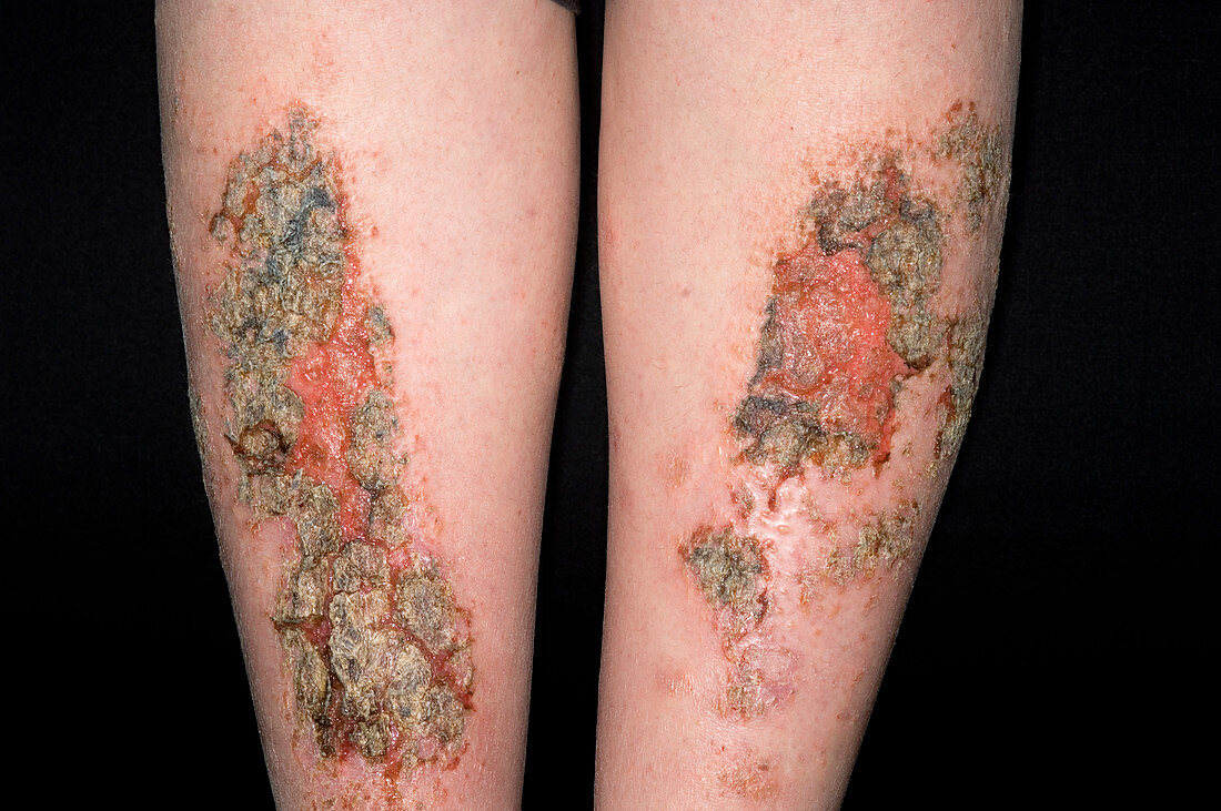 Infected eczema plaques