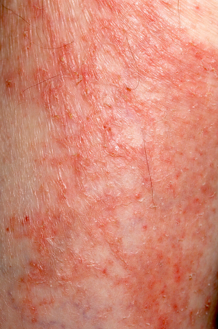 Eczema