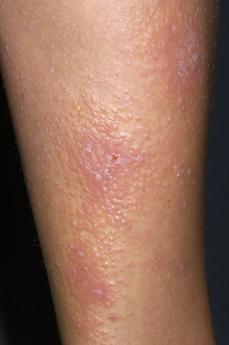 Discoid eczema