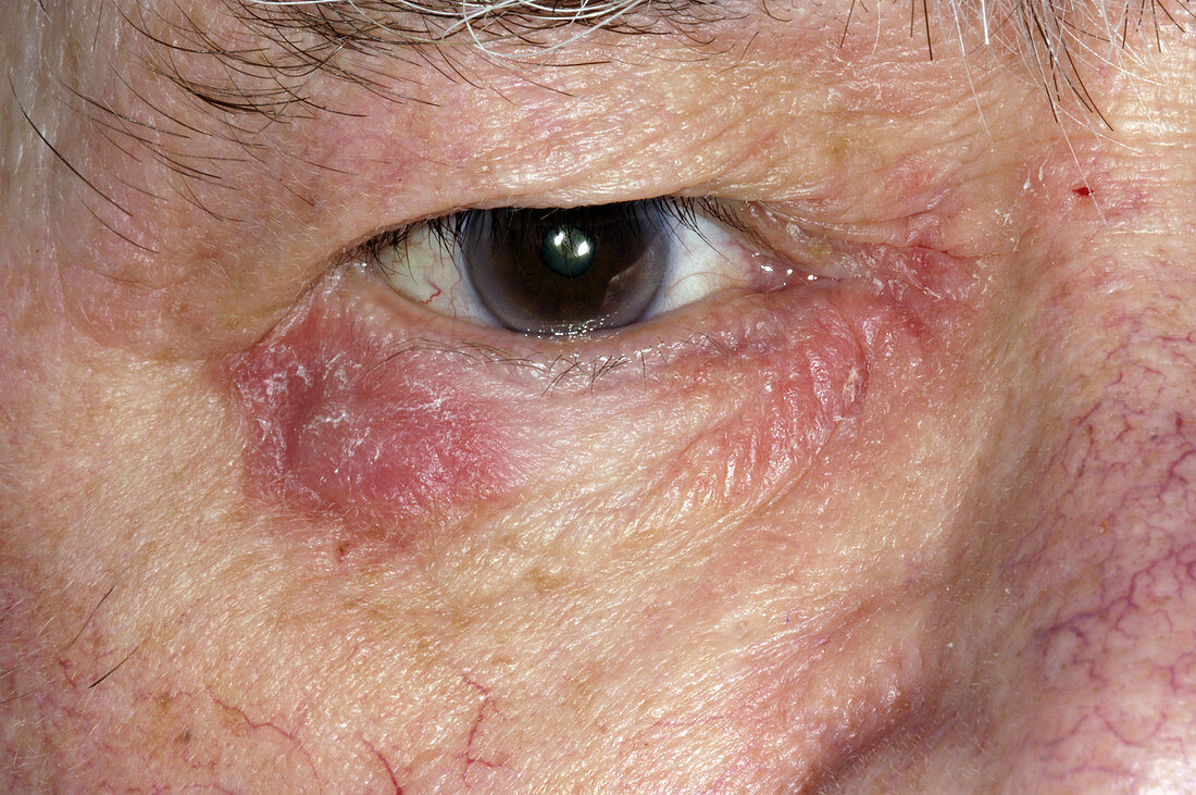 Eczema around the eye