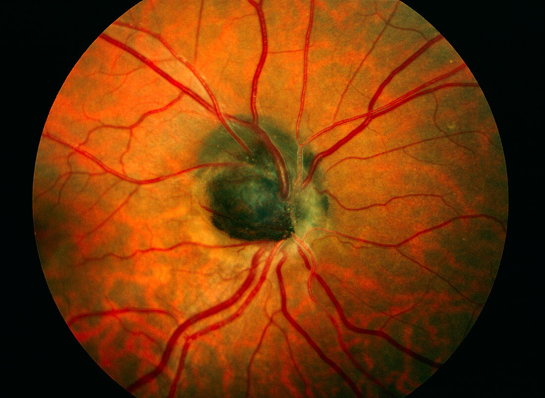 Benign eye tumour