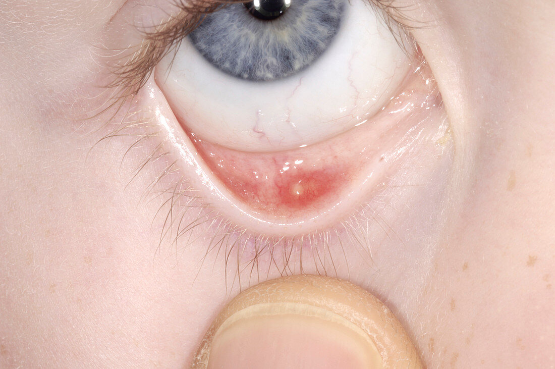 Cyst (chalazion) on eyelid