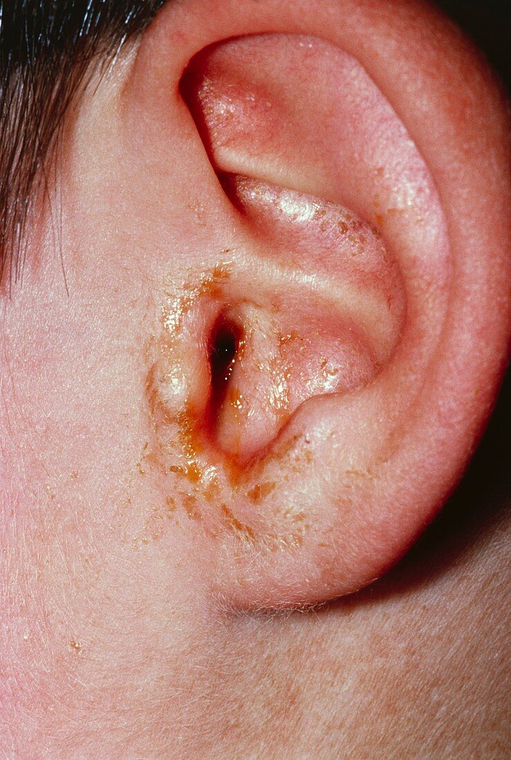 Ear affected by otitis media showing pus discharge