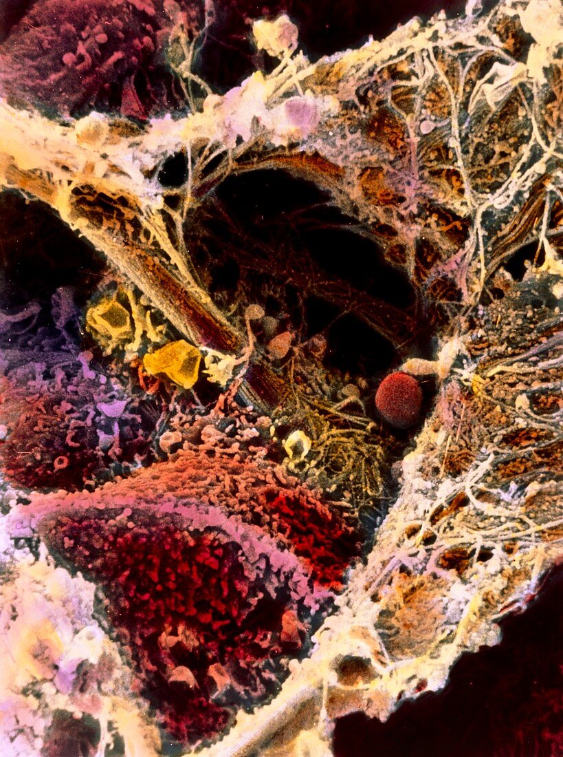 Coloured SEM showing liver fibrosis