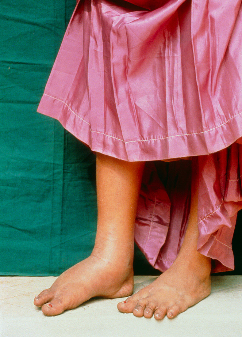 Leg of girl with early lymphatic filariasis