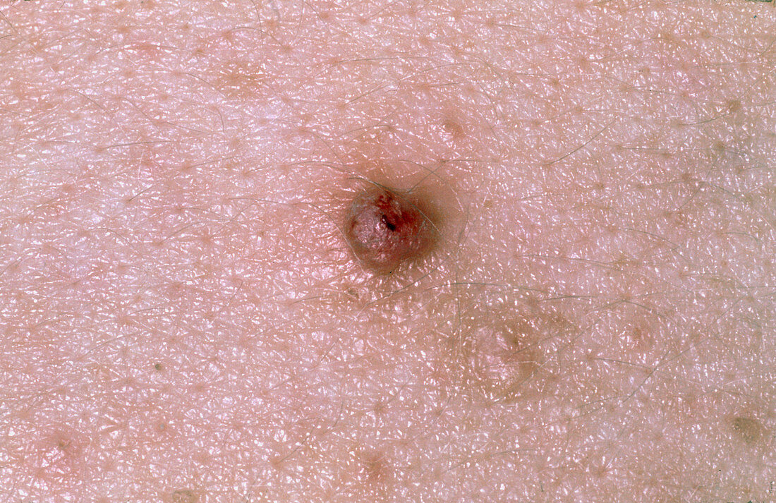 Close-up of red folliculitis lesion on skin