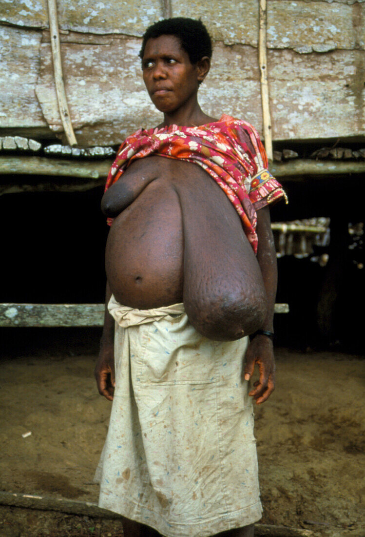 Woman with a breast enlarged by elephantiasis