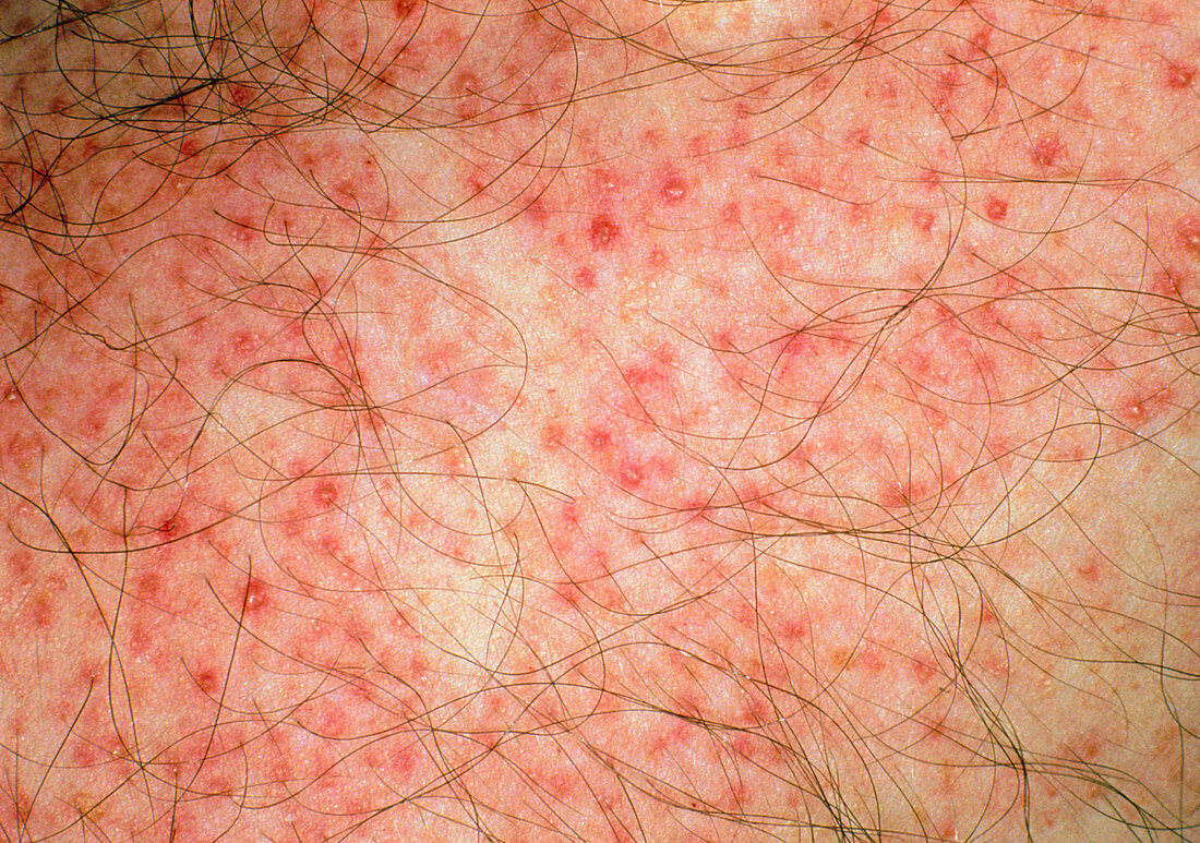 Close-up of red folliculitis papules on skin