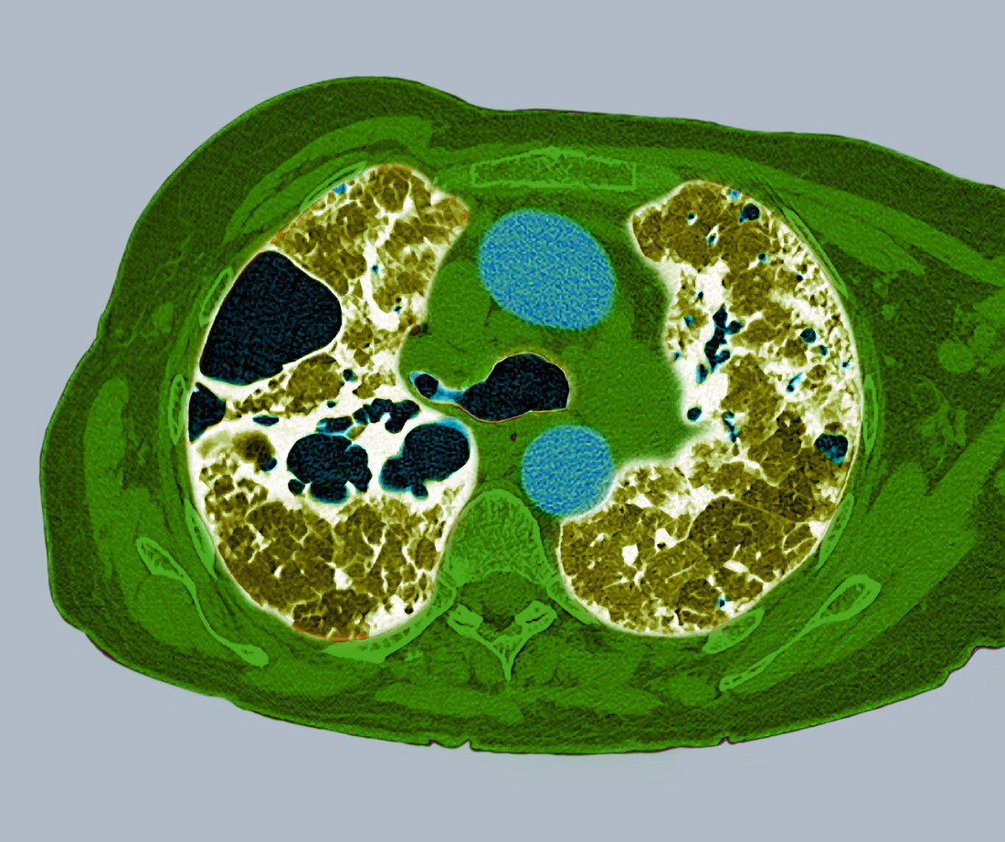 Lung fibrosis,CT scan