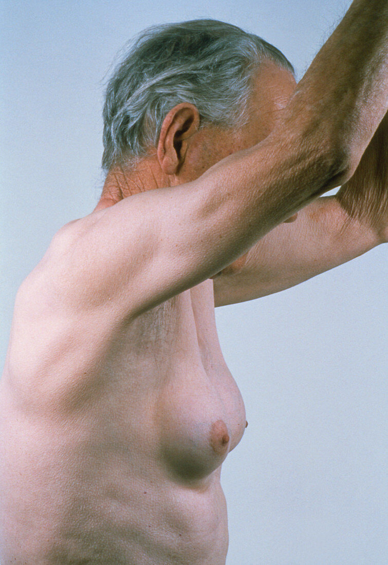 Gynaecomastia in man showing enlarged breasts