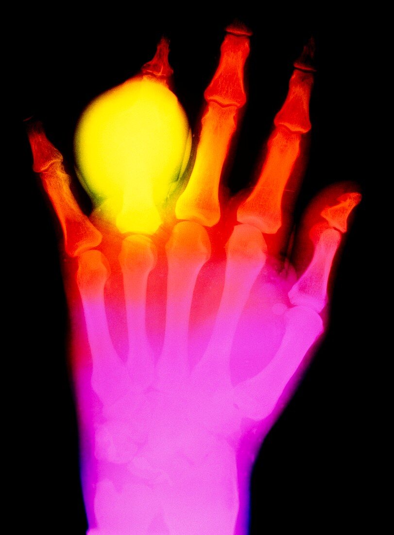 False-colour X-ray of hand in gouty arthritis