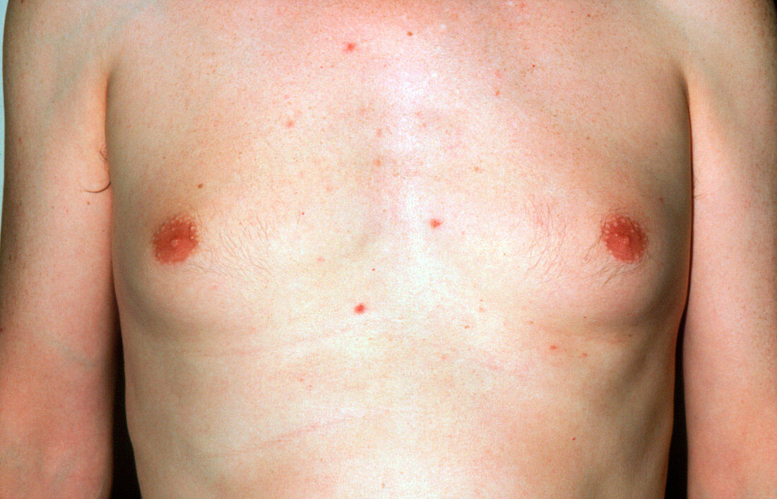 Gynaecomastia in a young man of unknown cause